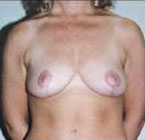Patient # 56755 After Photo # 2